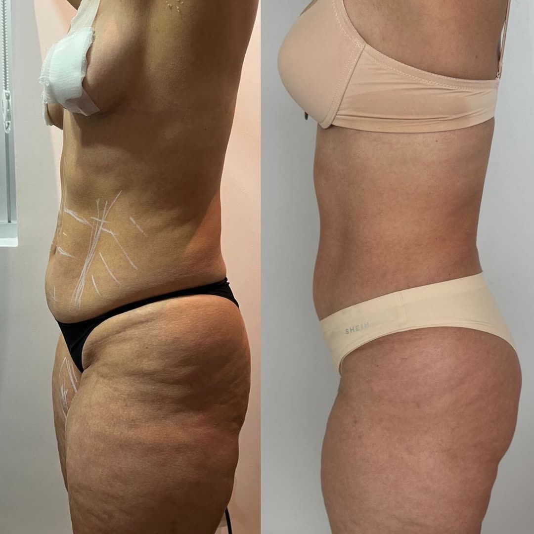Resultado de tratamento: Barriga