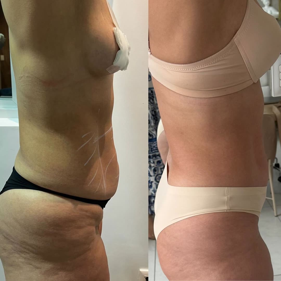 Resultado de tratamento: Barriga